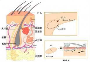 腋下多汗原因和治疗方法,脚手多汗腋窝多汗
