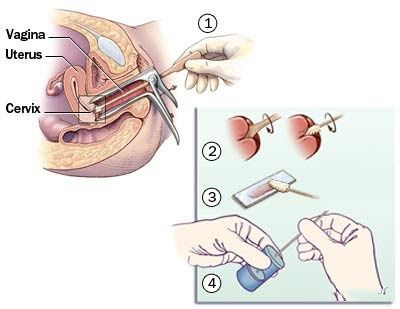 预防宫颈癌和乳腺癌的疫苗,预防乳腺癌宫颈癌的预防针多少钱