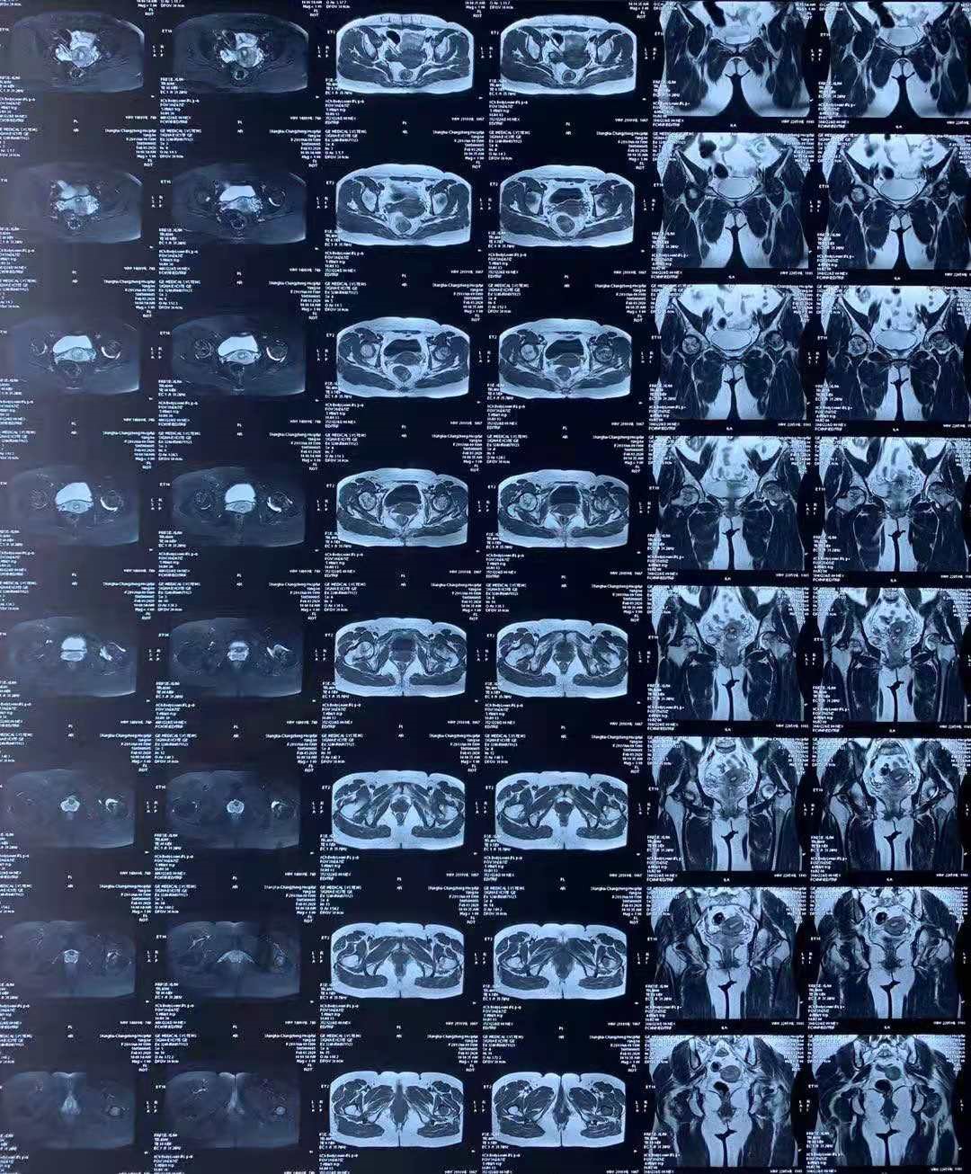 股骨头坏死分期分型图片,股骨头坏死的概念及临床分期特点