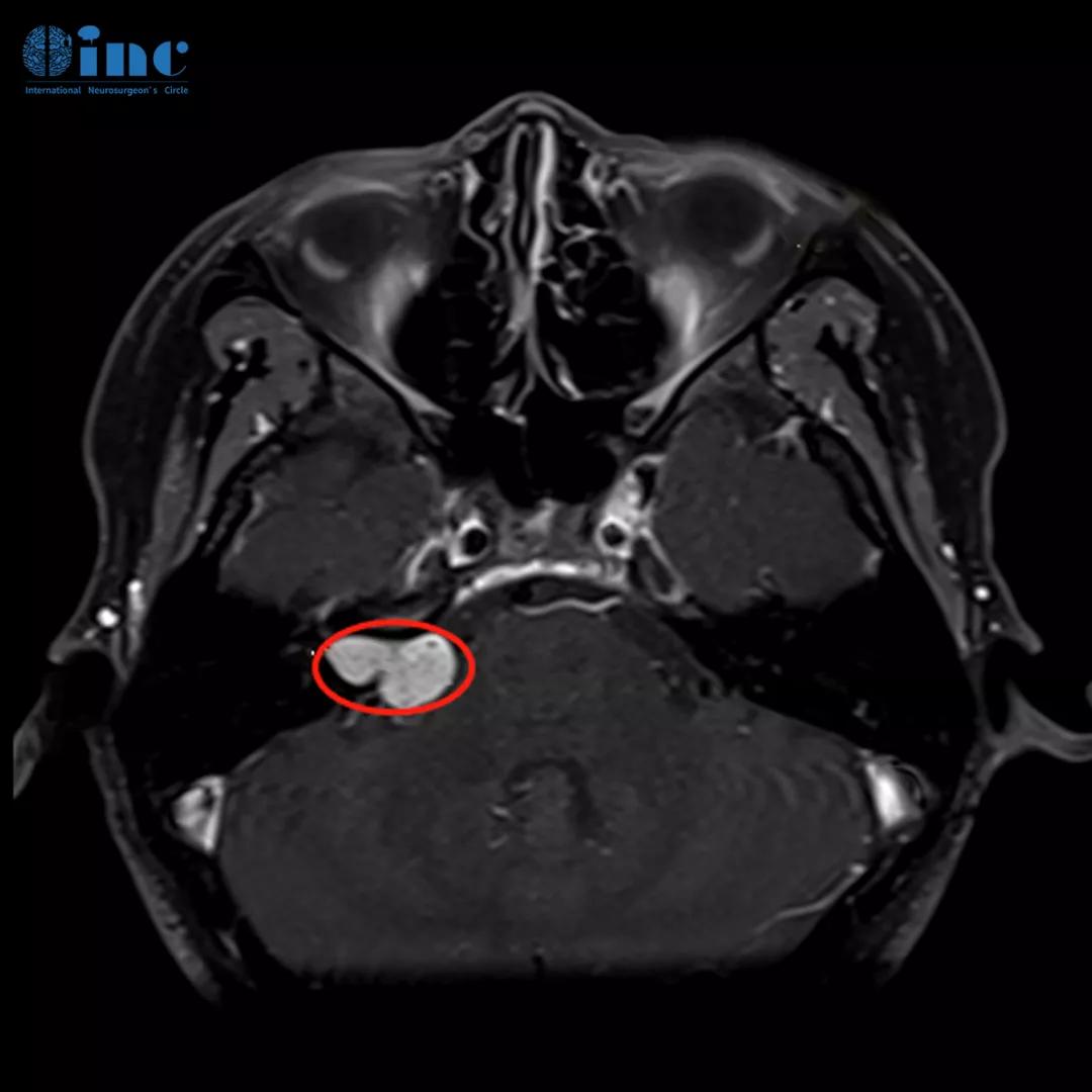 听神经瘤突聋能恢复吗,听神经瘤耳聋了怎么办