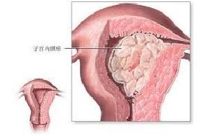 月经量不多一直不干净是内膜癌吗,月经拖拉不干净可能是内膜癌吗