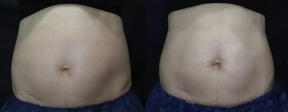 抽脂塑形央视新闻,央视提到减重代谢手术