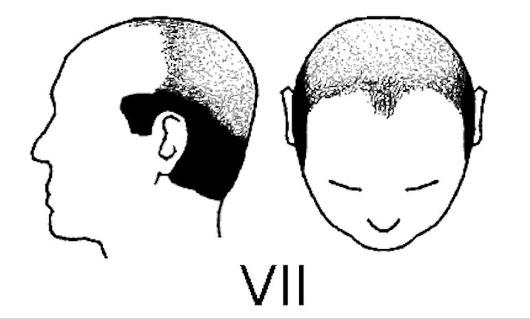中年男性脱发原因及治疗方法,中年男性遗传性脱发能治好吗