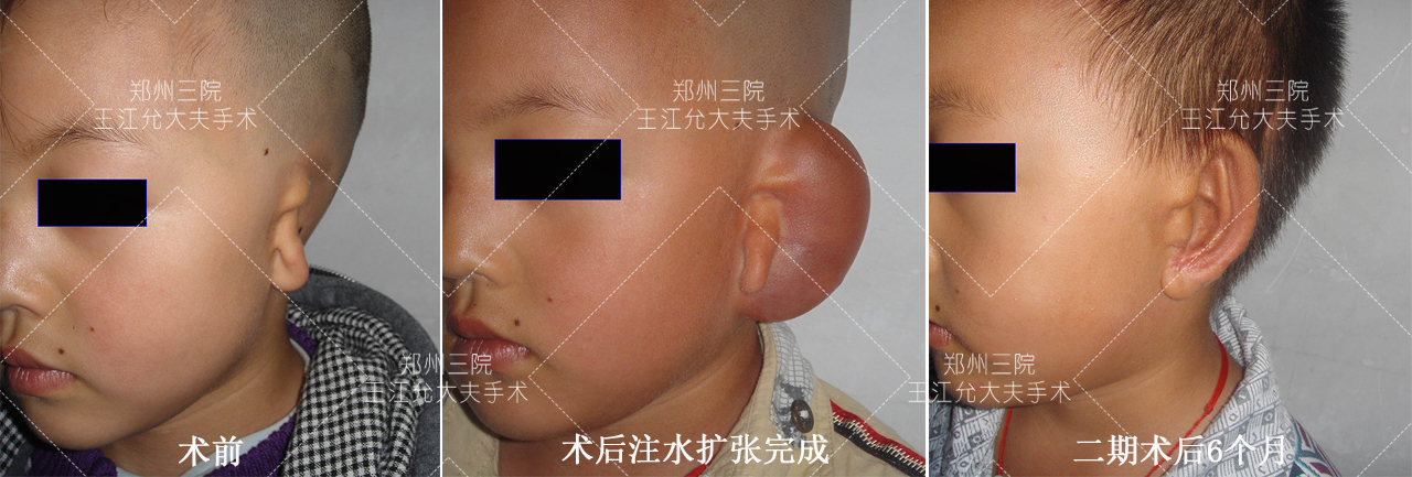 新生儿小耳畸形最佳治疗时间,新生儿耳朵轮廓畸形家长怎么办