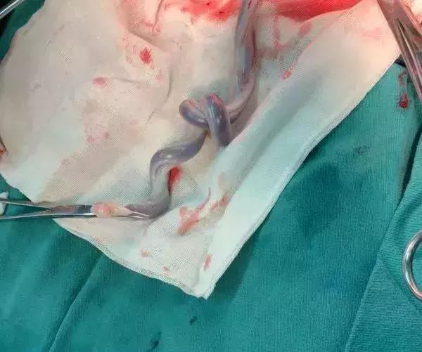 点赞丨紧急！高龄妈妈胎监图呈直线，多团队协作小天使平安降临