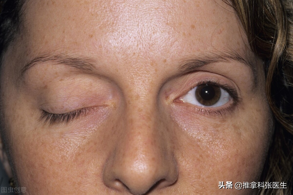 眼睛疼痛睁不开,眼睛疼痛睁不开眼睛怎么回事