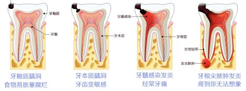 牙疼去医院一般怎么治疗,牙疼到半边脸痛去医院花多少钱