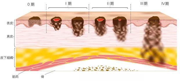 长在什么部位的痣最危险,长在哪些部位的痣需要特别注意