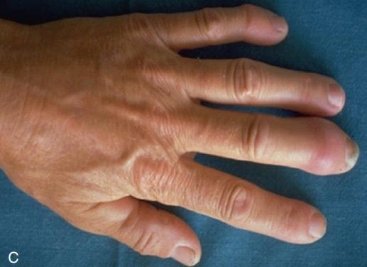 牛皮癣是严重疾病吗,牛皮癣属于什么类疾病