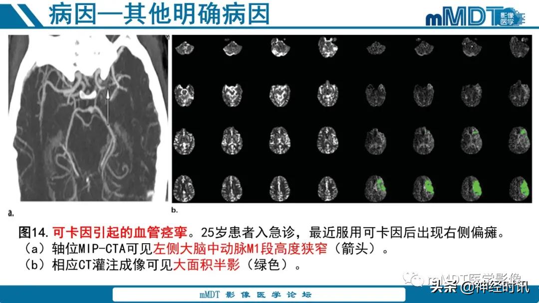 缺血性脑卒中护理课件,缺血性脑卒中讲课ppt