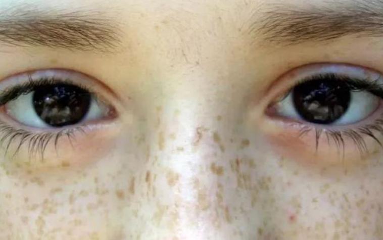 祛天生雀斑的最佳方法,脸上雀斑怎么样能祛掉