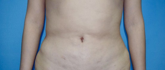 大腿吸脂失败了什么时候可以修复,吸脂失败后如何修复