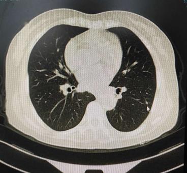 50岁女肺部8毫米结节治疗过程,女士肺结节康复