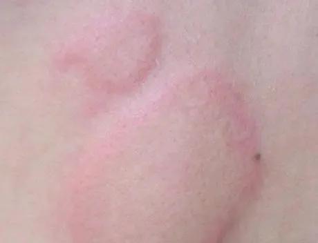 痒痒怎么办小妙招,痒痒用什么方法可以缓解