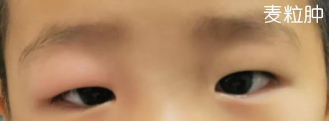眼睛感染过后麦粒肿还是霰粒肿,眼皮红肿麦粒肿霰粒肿形成机理