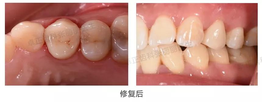 牙齿楔状缺损修复图片,牙齿楔状缺损修复大概多少钱