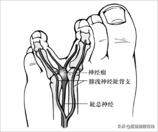 走路时脚的外面会一阵一阵的疼,走路时膝盖处突然刺痛是怎么回事