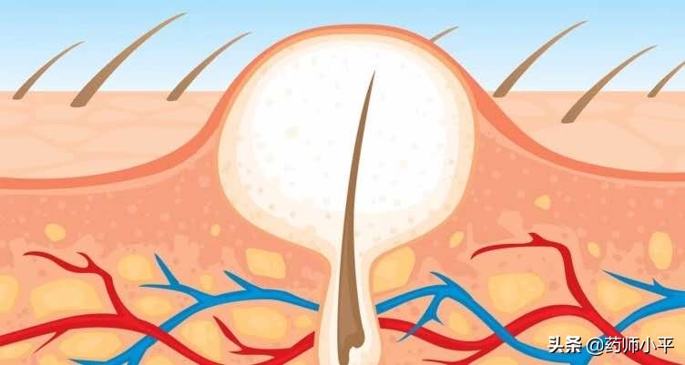 仅需三步带你了解痘痘的成因,痘痘是怎么长出来的过程