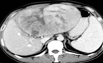 发现肝脏实性占位后做什么检查,肝脏阴影或占位有可能是哪些病