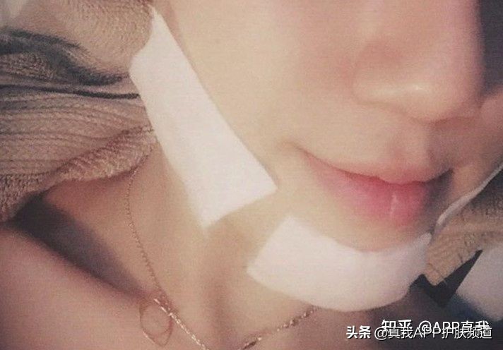 皮肤刷酸到底是什么意思,皮肤刷酸多久一次比较好