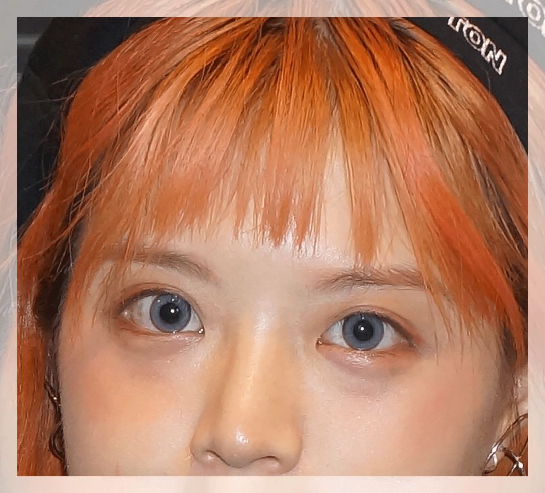 花了10800块去黑眼圈没效果,网上治疗黑眼圈靠谱么