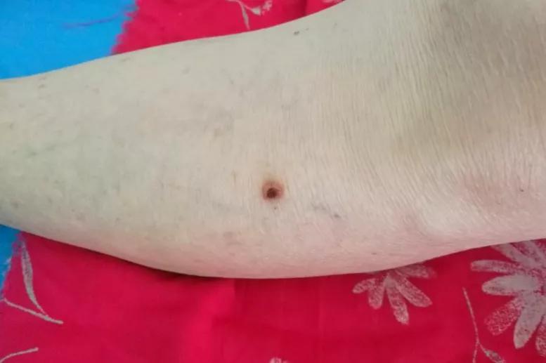 潍坊肺结节微创手术,潍坊市治疗肺部结节的中医