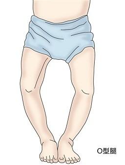 儿童膝内翻去哪里治疗,膝内翻如何矫正儿童