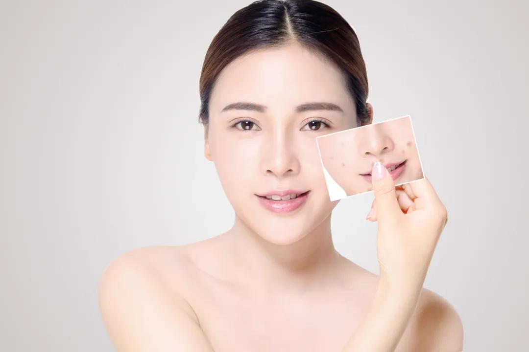 毛孔粗大黑头粉刺闭口护肤测评,毛孔粗大有闭口如何护肤