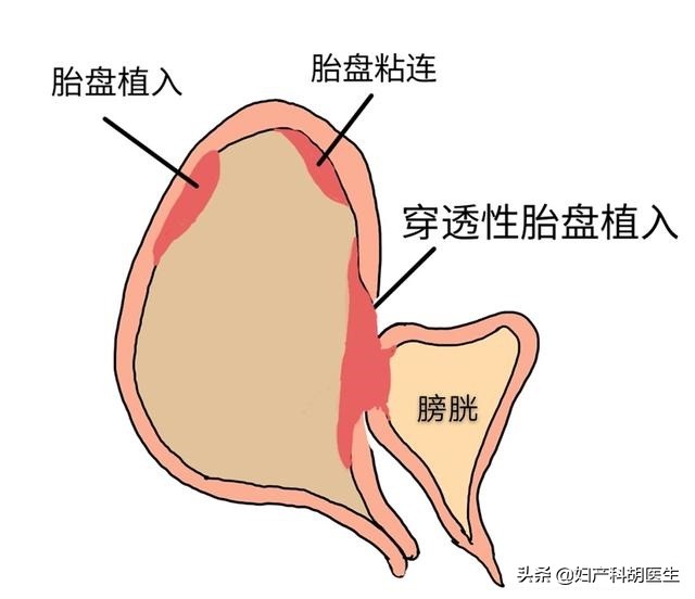 孕妇胎盘辟谣,一胎胎盘粘连后又怀孕不想要了