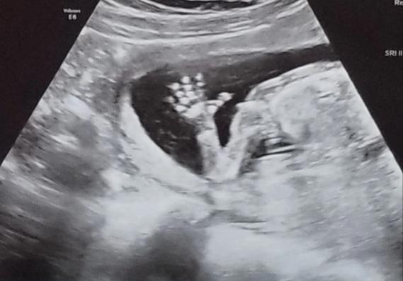 美国双子宫女子诞下双胞胎,美国女教师怀孕事件