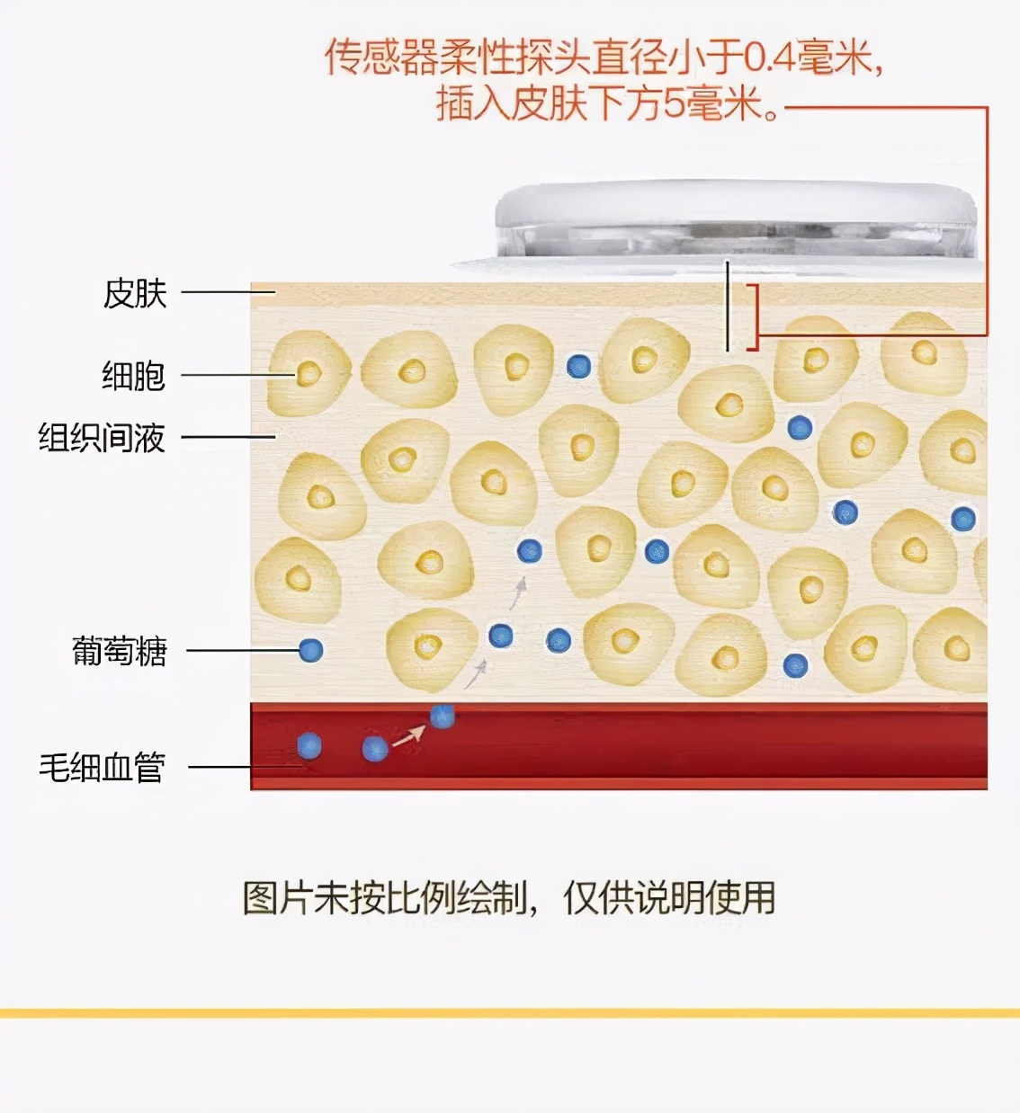 雅培瞬感是糖尿病患者用的吗,雅培瞬感血糖仪测不到血糖
