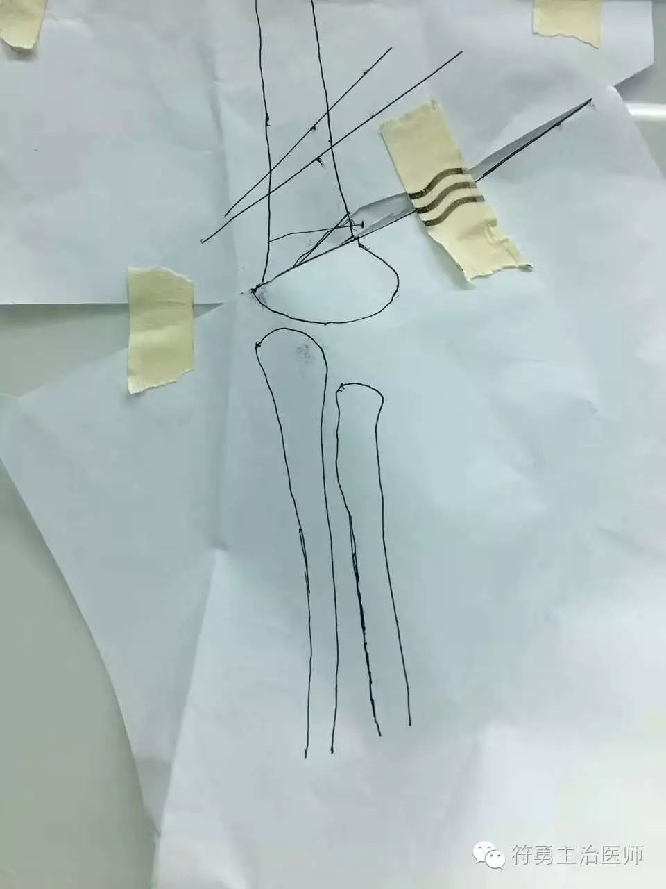 手臂肘内翻的手术效果,胳膊肘内翻矫正手术28年费用