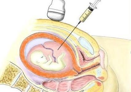 无创检查和羊水穿刺检查有啥区别,羊水穿刺检查是怎么做的