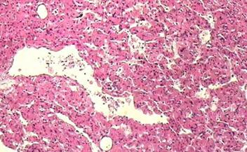 肾上长错构瘤怎么办,肾错构瘤是什么意思