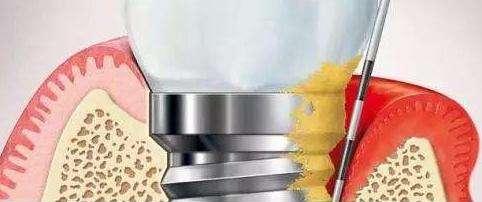 牙周炎松动拔掉再种植好吗,牙齿松动种植什么牙齿好