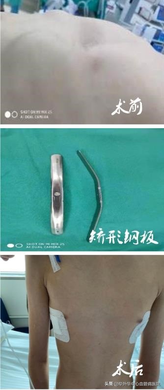 漏斗胸鸡胸矫正术,少年漏斗胸非手术治疗办法