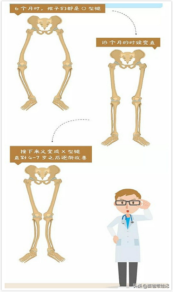 宝宝x型腿一定要治疗吗,宝宝x型腿例子