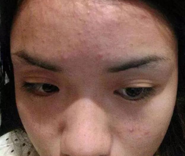 月球脸怎么改善,脸上像月球坑一样的怎么除掉