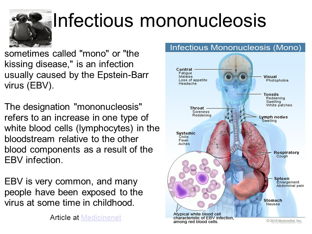 eb病毒感染是单核细胞增多吗,eb病毒感染症状有时候轻有时候重