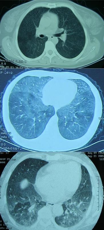 养鸽子造成皮肤真菌感染,养鸽子会得肺炎吗