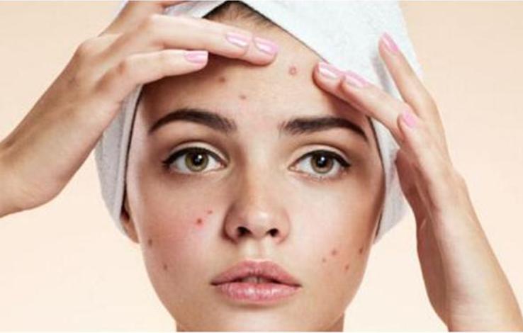 脸上有痘印该用去痘印精华吗,反复起痘有痘印应该用什么精华