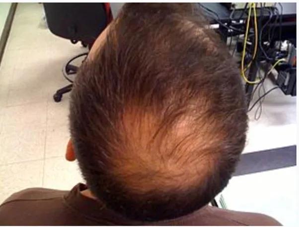 儿童脱发会是什么病的前兆,孩子毛囊引起的脱发怎么办