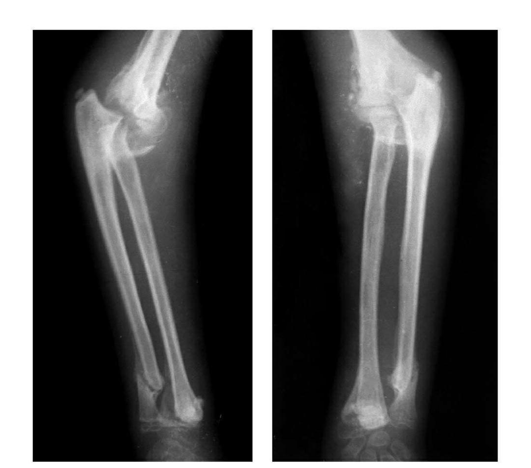 青少年肘部损伤最常见的是,肘部桡神经损伤的临床表现