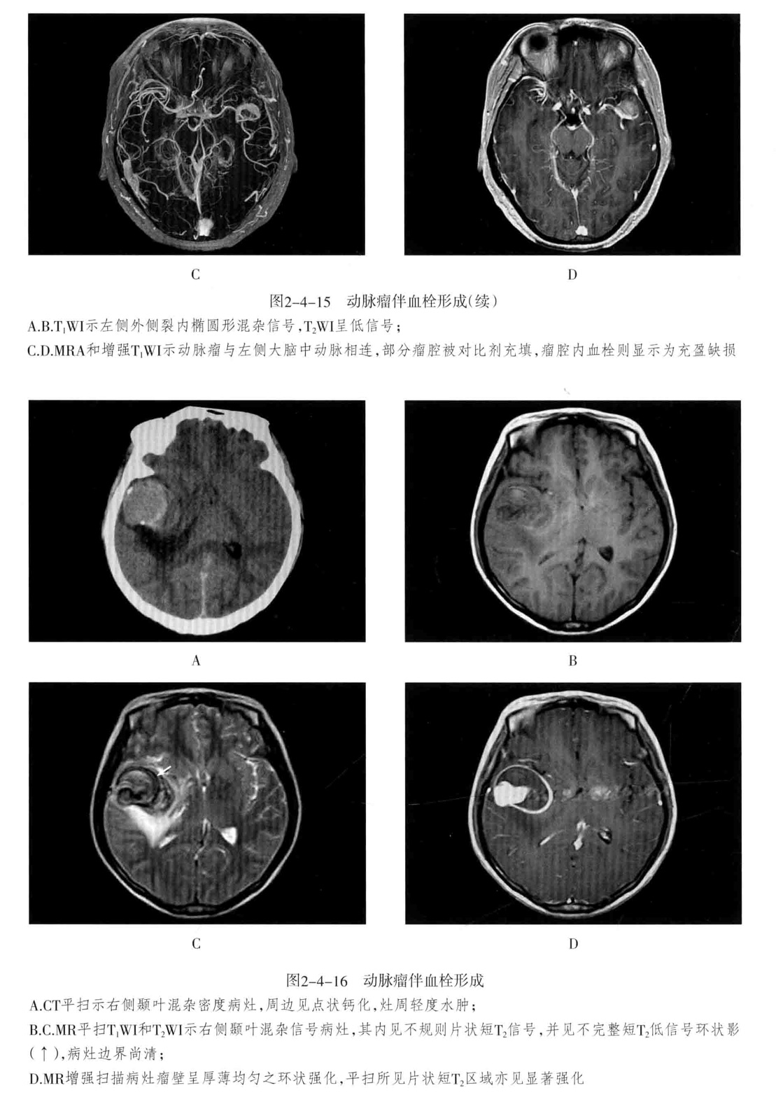颅内血管周围间隙的影像鉴别,颅脑血管源性疾病影像诊断