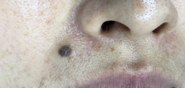 起痣是用药好还是用激光好,点长毛的痣需要手术还是激光