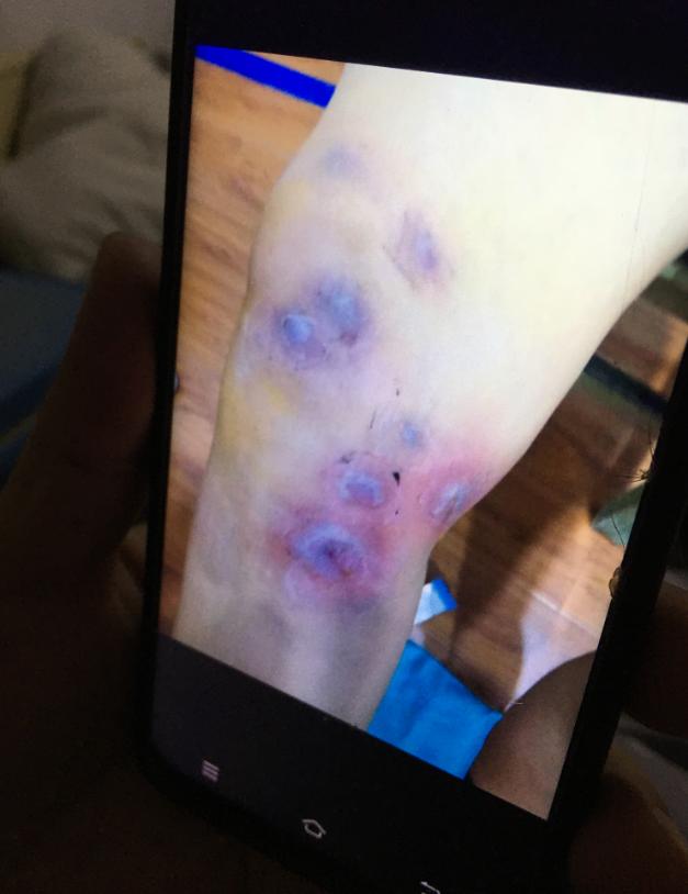 河南杞县115人针灸后针眼溃烂：针灸前被注射药物，事发后仍有人苦求继续针灸，患者需手术切开伤口排脓
