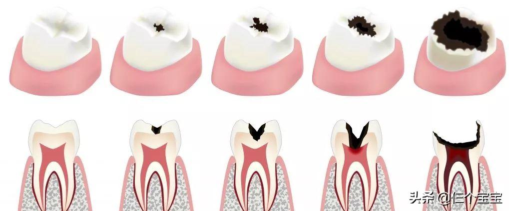 草莓籽在嘴里发了芽？刷牙少了这一步，你真的只是刷了个寂寞