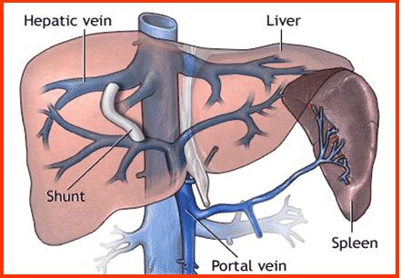 肝硬化引起门脉高压消化道出血,肝硬化消化道大出血怎么治疗