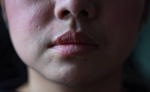 嘴上口腔起泡怎么办,嘴上长泡是上火还是疱疹