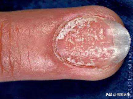 指甲有白点肚子里有蛔虫？月牙越大越健康？指甲软是缺钙……